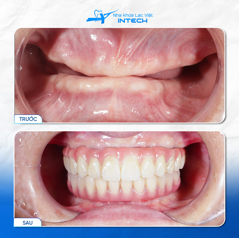 Phương pháp trồng Implant All-On-4 và All-On-6 được nhiều cô chú/anh chị lựa chọn vì phục hình toàn hàm hiệu quả mà tiết kiệm chi phí