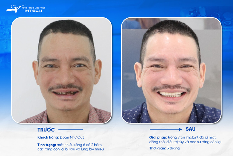 Trồng răng Implant là phương pháp phục hình răng bền vững và an toàn nhất hiện nay