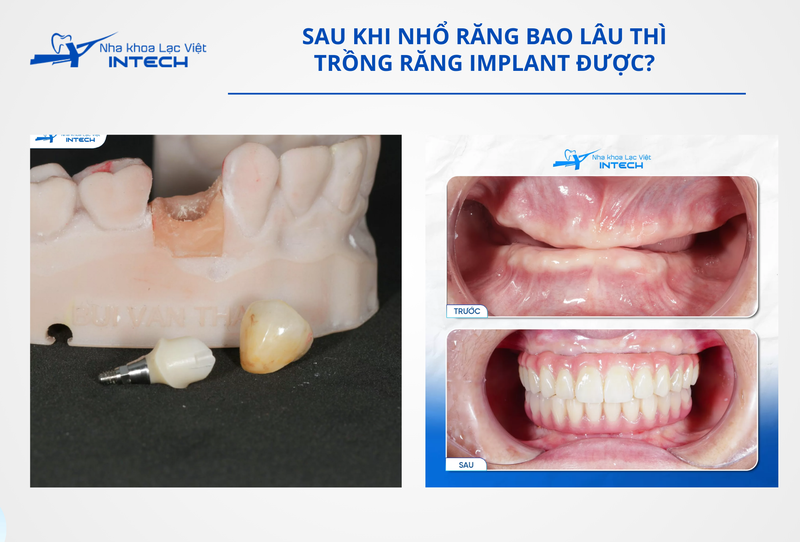 Cô chú/anh chị nên thực hiện cấy ghép răng Implant càng sớm càng tốt để hạn chế các biến chứng