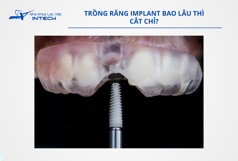 Cô chú/anh chị thường sẽ được hẹn cắt chỉ sau khoảng 10 - 15 ngày
