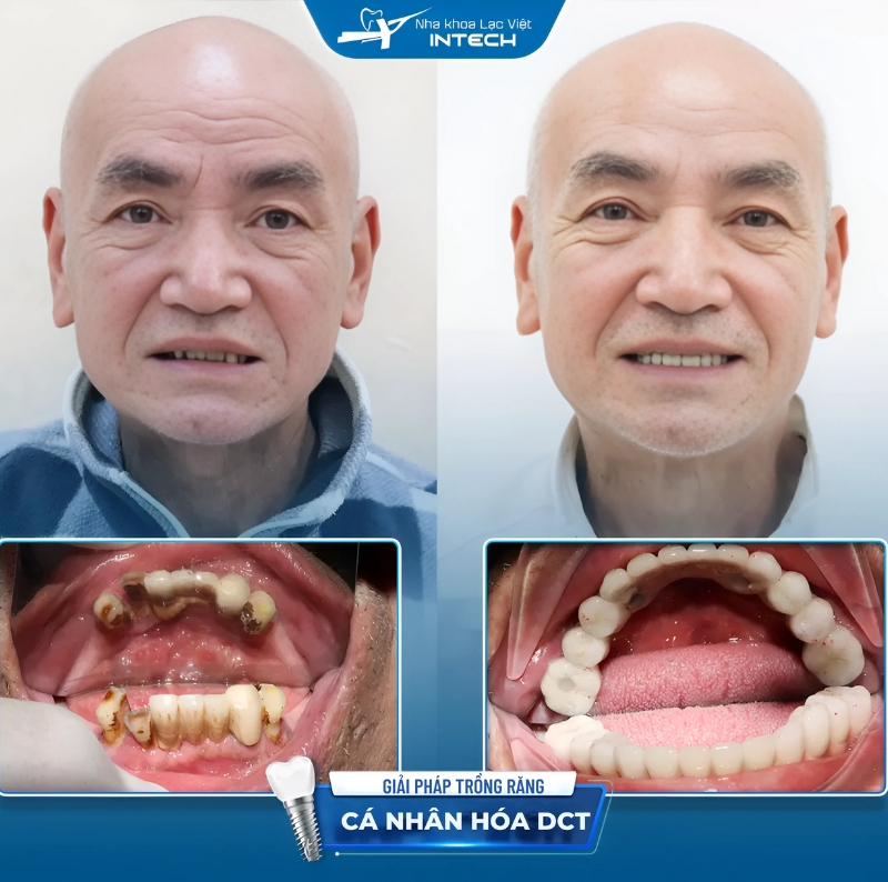 Chú Đới Xuân Sơn với tình trạng nhiều răng hàm trên và hàm dưới hư hỏng nặng, đã thực hiện trồng răng Implant toàn hàm tại nha khoa Lạc Việt Intech cơ sở Hải Phòng