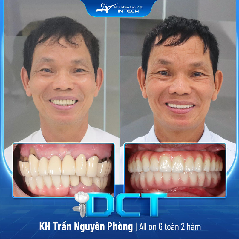Chú Trần Nguyên Phòng thực hiện trồng răng Implant toàn hàm với giải pháp cá nhân hóa DCT cho kết quả tự nhiên như răng thật (hình bên phải)