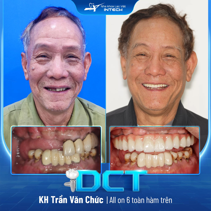 Chú Trần Nguyên Phòng thực hiện trồng răng Implant toàn hàm với giải pháp cá nhân hóa DCT cho kết quả tự nhiên như răng thật (hình bên phải)