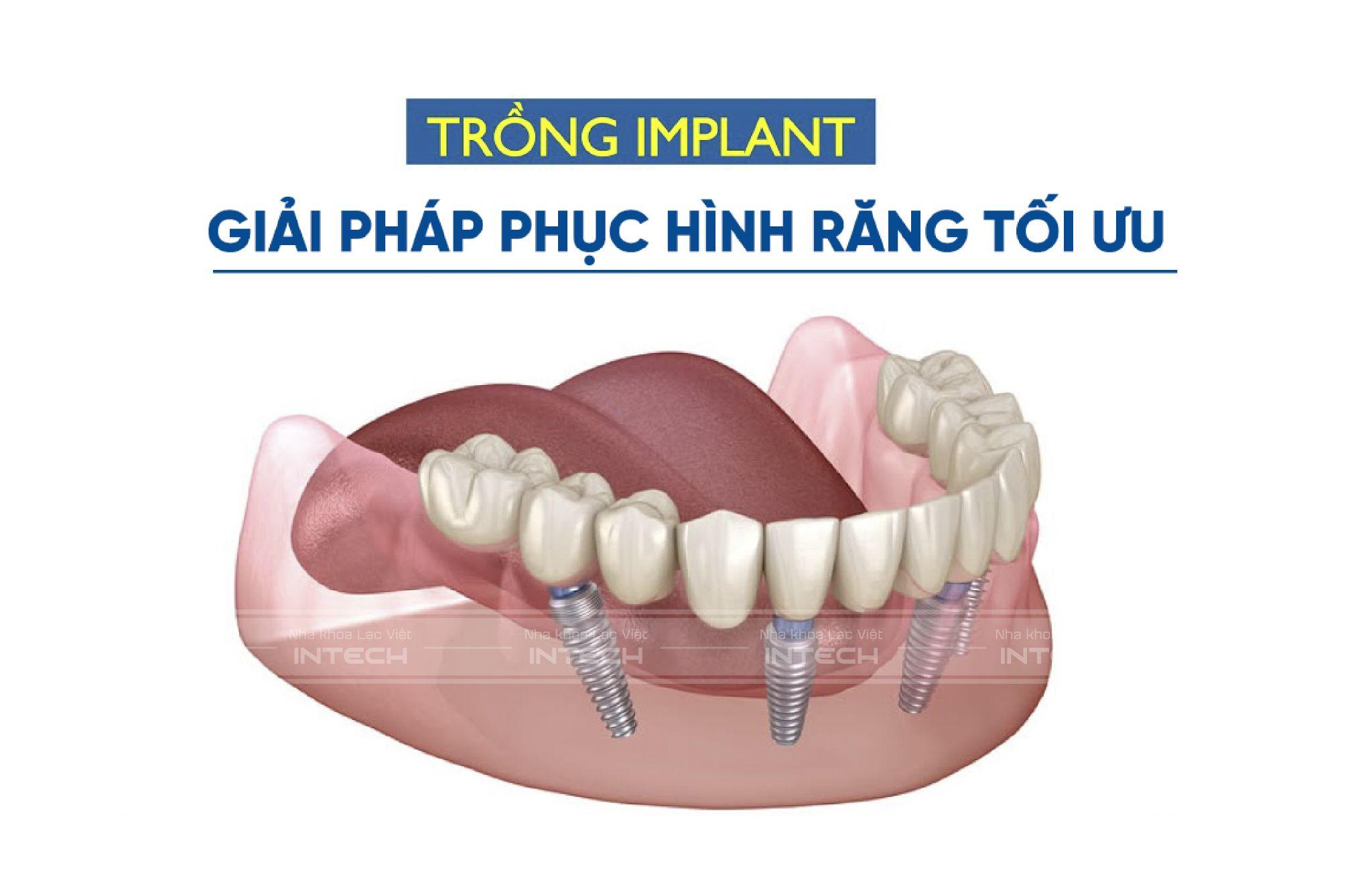 Trồng răng Implant chính là phương pháp phục hình răng tối ưu nhất
