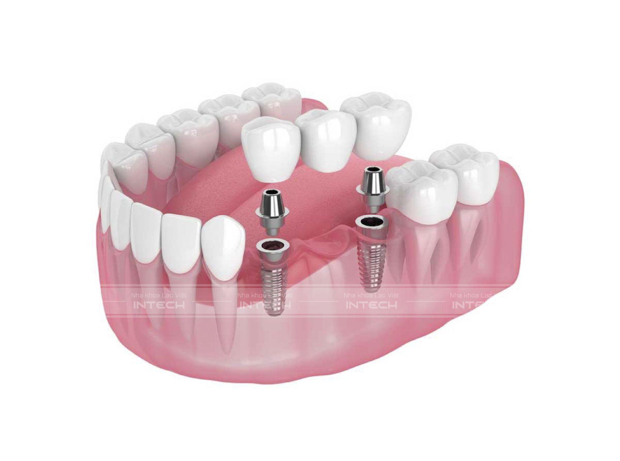 Kỹ thuật phục hình răng sứ trên Implant sai cách sẽ khiến thức ăn dễ mắc vào kẽ răng