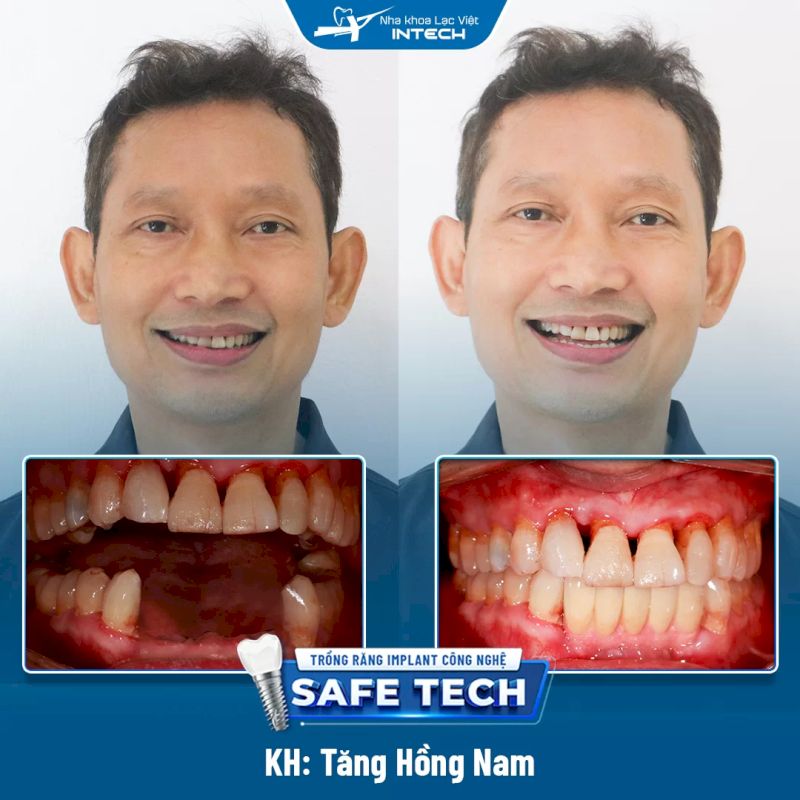 Chú Tăng Hồng Nam với tình trạng mất nhiều răng cửa liên tiếp đã thực hiện trồng răng Implant tại Lạc Việt Intech Vinh