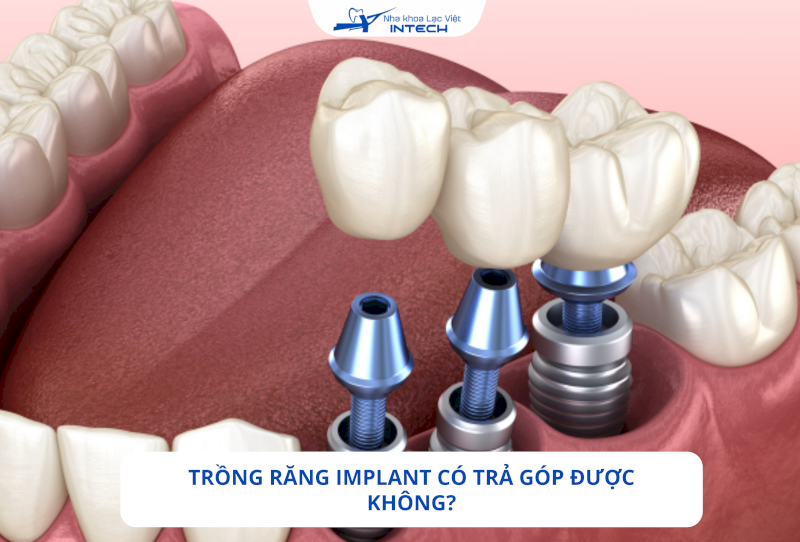 Trồng răng Implant trả góp được không?