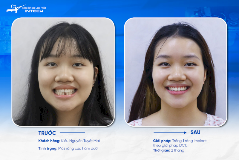Trồng Implant đơn lẻ với hình thức trả góp giúp cô chú/anh chị cấy ghép Implant sớm với chi phí hợp lý hơn