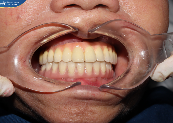 Trồng răng nguyên hàm bằng implant - Bước ngoặt mới trong ngành nha khoa