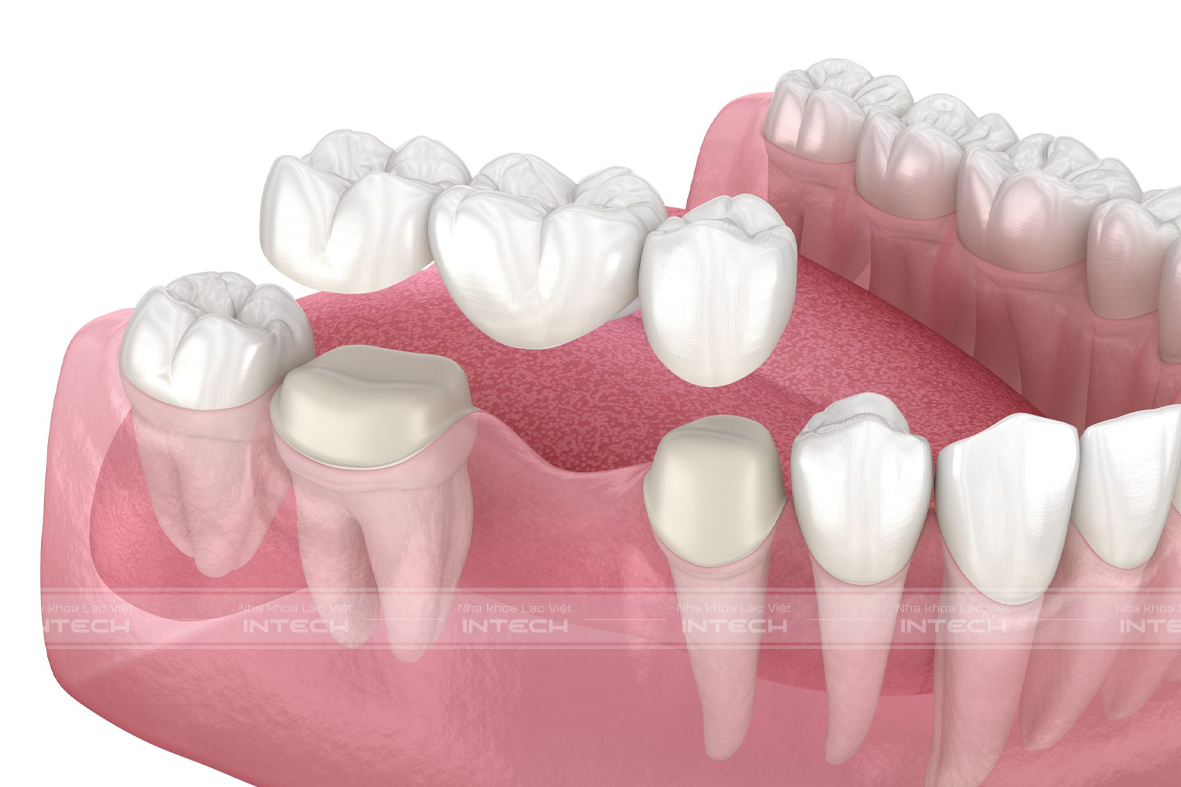Trồng răng sứ bằng bắc cầu răng sứ