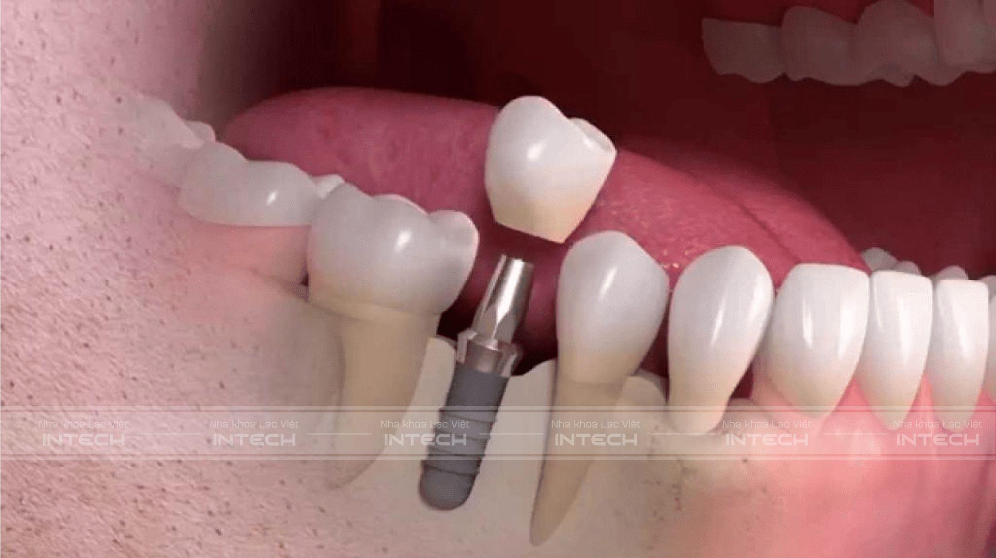 Trồng răng sứ bằng cấy ghép Implant