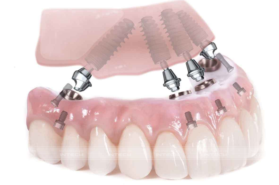 Trường hợp trồng răng toàn hàm sẽ không thể niềng răng được