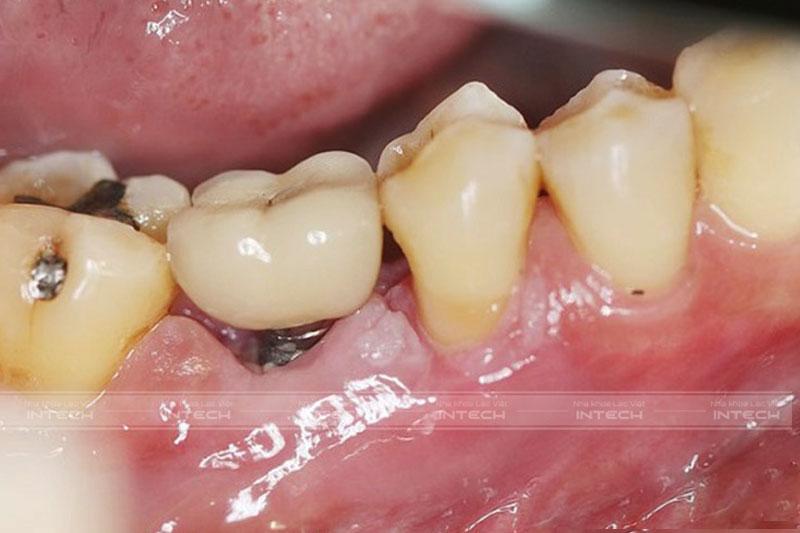 Trụ Implant bị đào thải sau cấy ghép khi không có đủ mật độ xương