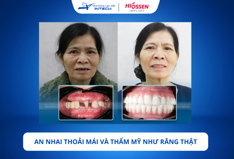 Khi hoàn thiện, răng Implant mang lại cảm giác ăn nhai thoải mái như răng thật, cô chú/anh chị có thể tự tin thưởng thức mọi món ăn yêu thích
