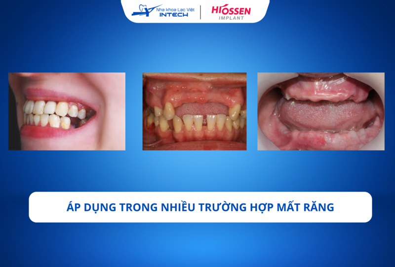 Trụ Implant HiOssen có thể được sử dụng hiệu quả trong nhiều tình huống mất răng khác nhau.