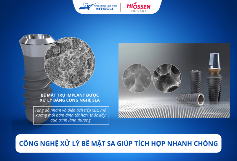 Trụ Implant HiOssen sử dụng công nghệ SA, tăng diện tích tiếp xúc với xương hàm, cải thiện khả năng tích hợp và độ bền