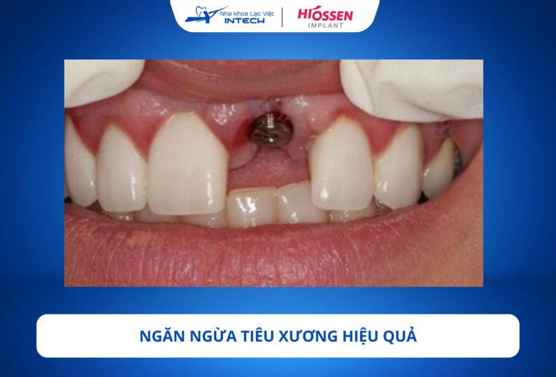Trụ tạo lực kích thích tự nhiên lên xương hàm mỗi khi ăn nhai, giúp ngăn chặn hiệu quả hiện tượng tiêu xương