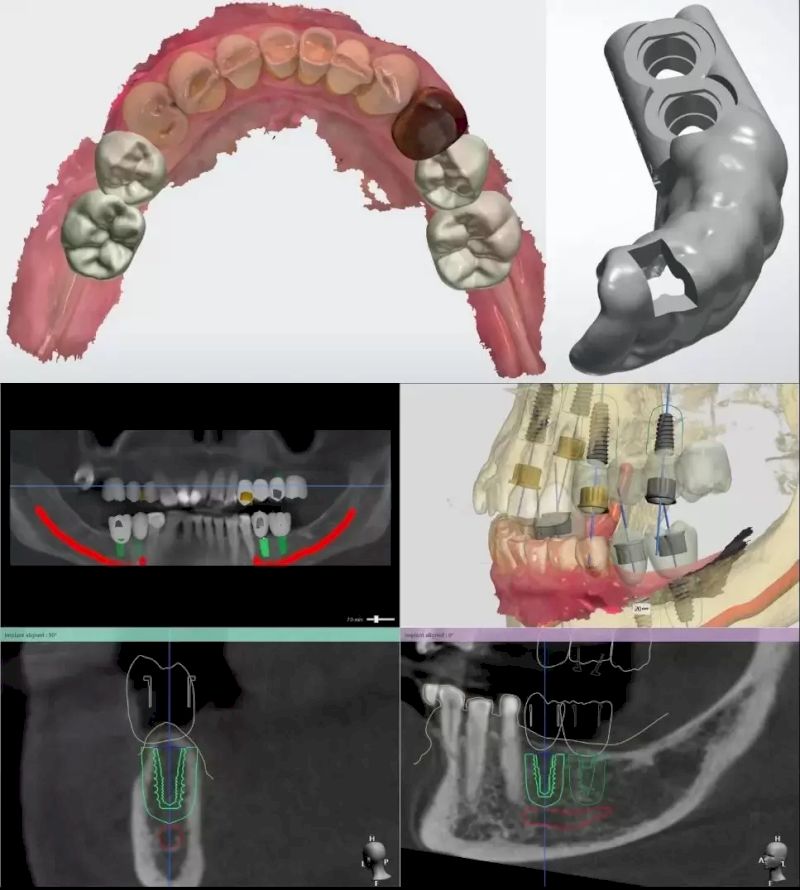 Giải pháp trồng răng Implant cá nhân hóa DCT sử dụng máng hướng dẫn phẫu thuật