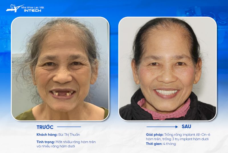 Implant Neo Active có tuổi thọ cao, được sản xuất chính hãng trên toàn cầu