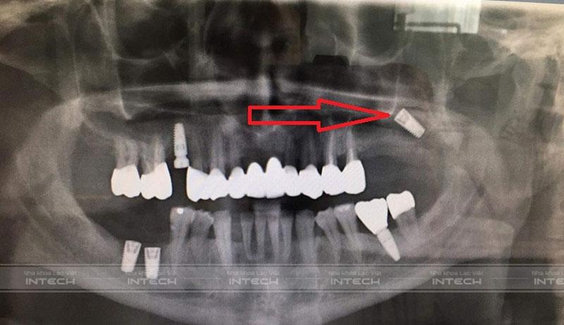 Trụ Implant bị rơi vào trong xoang hàm