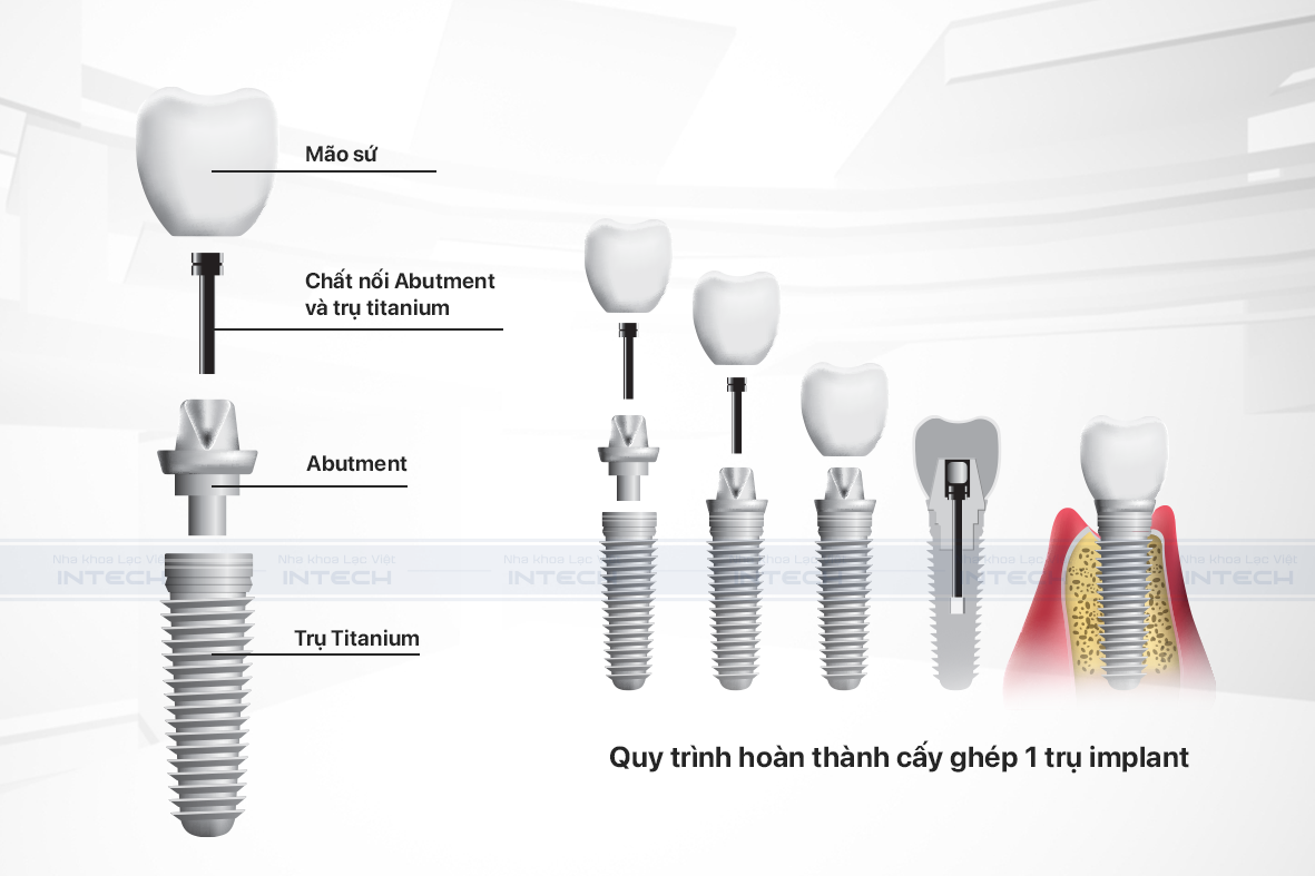 Sử dụng được cho hầu hết các trường hợp mất răng