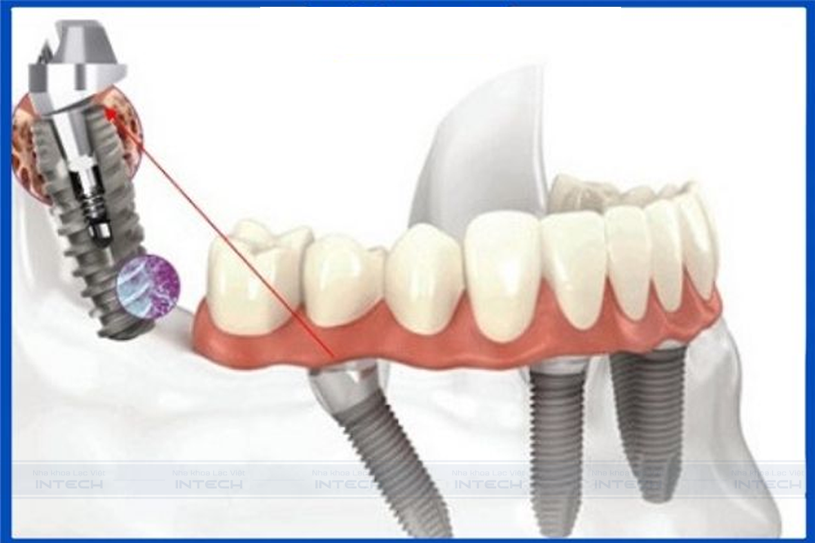 Trụ Straumann SLA khả năng tích hợp nhanh chóng