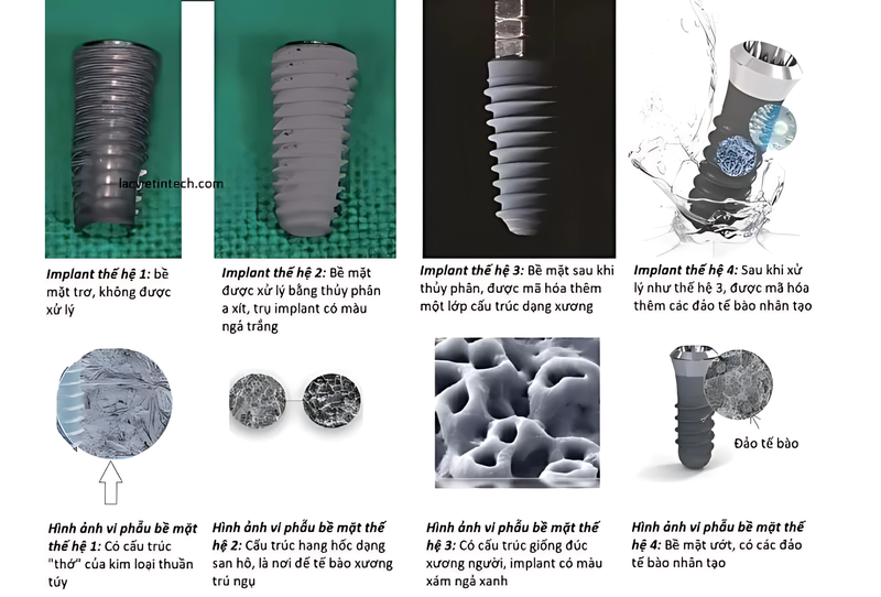 Hiện tại, trụ Implant đã trải qua 4 thế hệ công nghệ xử lý bề mặt khác nhau, cho hiệu quả tích hợp xương khác nhau