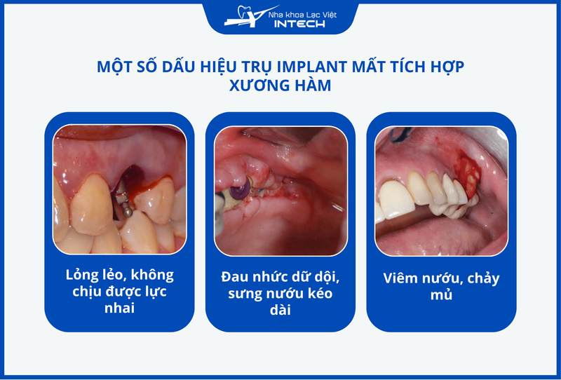 Trụ Implant không được xử lý bề mặt tốt sẽ làm gia tăng nguy cơ mất tích hợp xương hàm, đào thải trụ