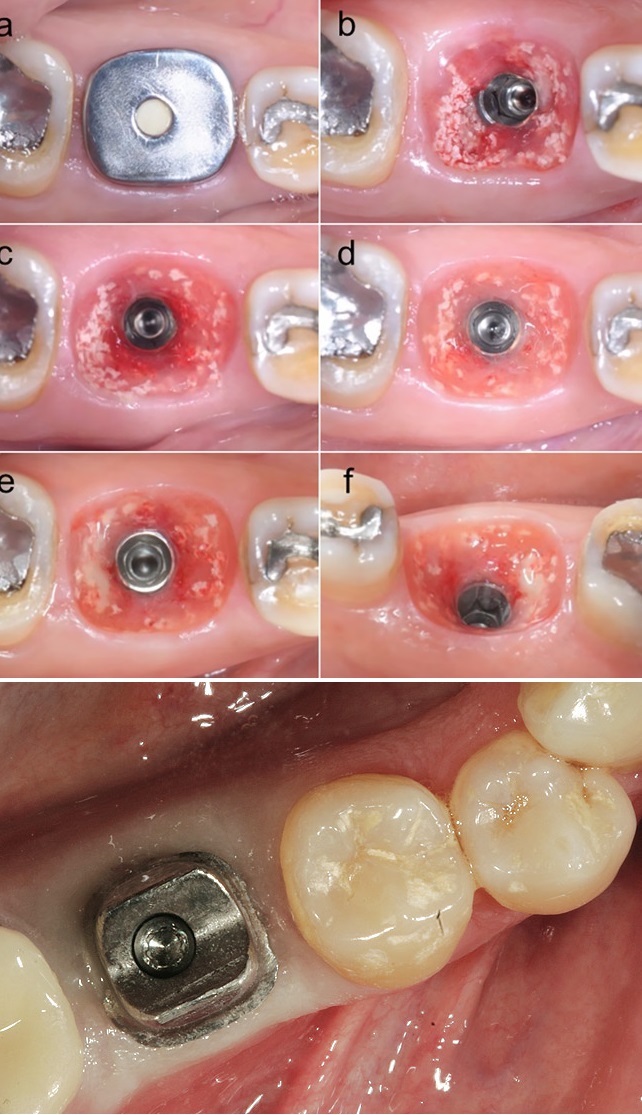 giải pháp trồng răng implant DCT
