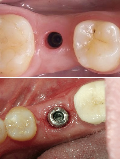 Trồng răng implant cá nhân hóa