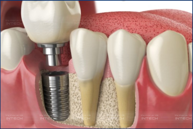 Trụ Implant Superline tích hợp xương hàm