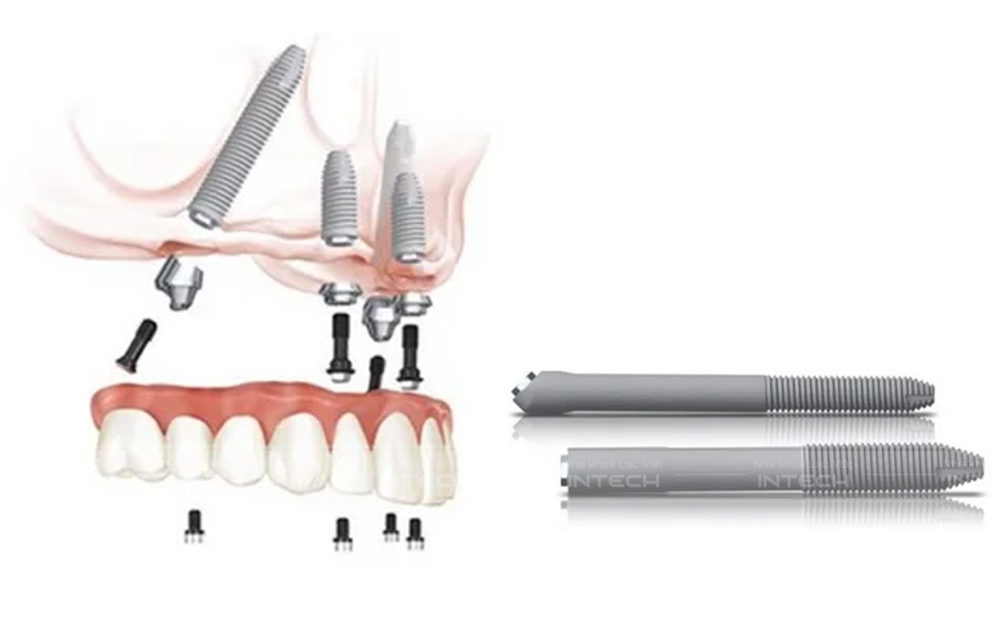 Trụ Zygoma implant được đặt với góc nghiêng - 45° hoặc 60°