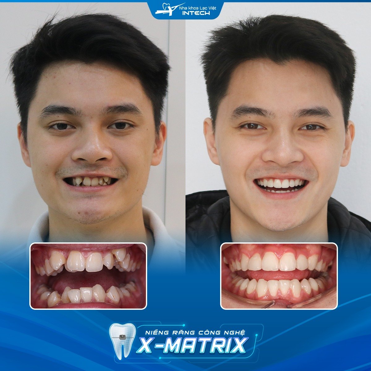 Niềng răng khấp khểnh tahy đổi như thế nào
