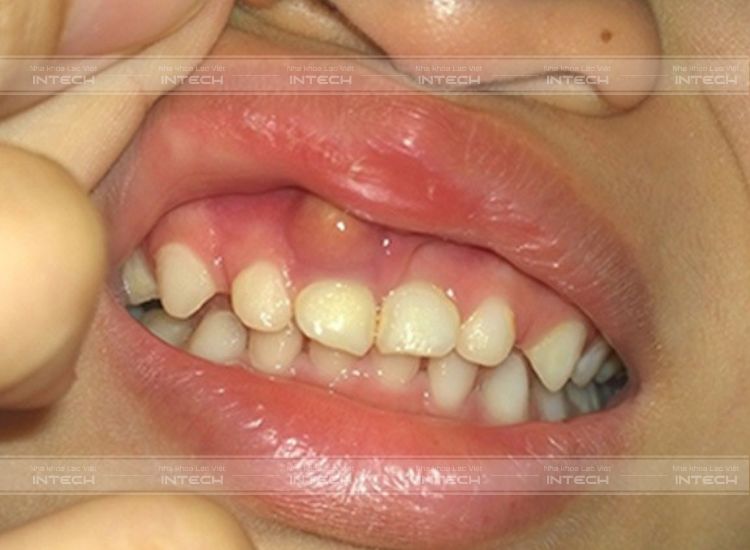 Hình thành túi mủ trên nướu răng