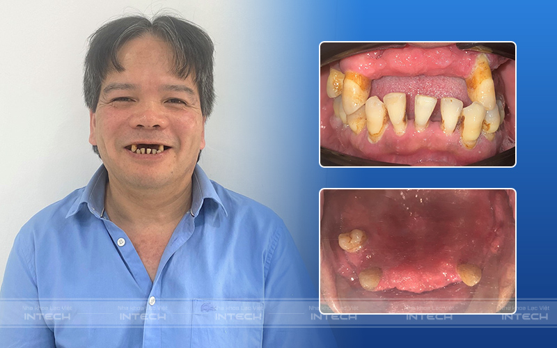 Tình trạng răng ban đầu của khách hàng Nguyễn Văn Minh