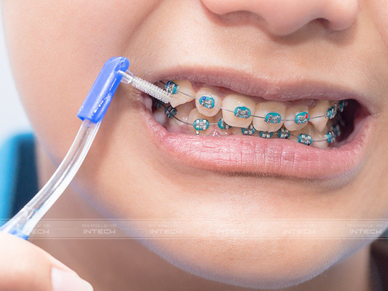 Sử dụng bàn chải kẽ để nhẹ nhàng loại bỏ các sợi thức ăn thừa còn dính trên răng hay trên mắc cài