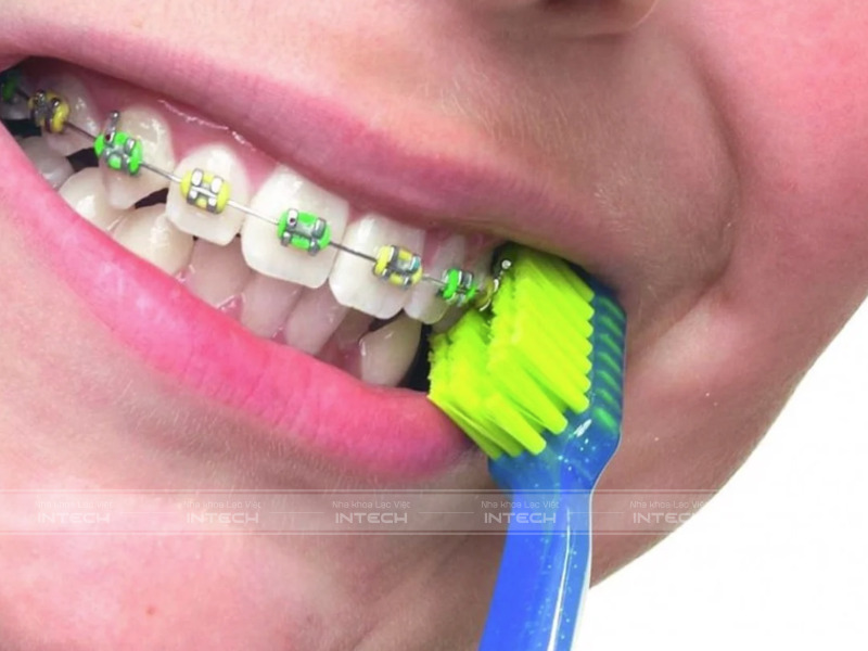 Hãy sử dụng các loại bàn chải có lông mềm, kích thước nhỏ, vừa vặn với khuôn miệng