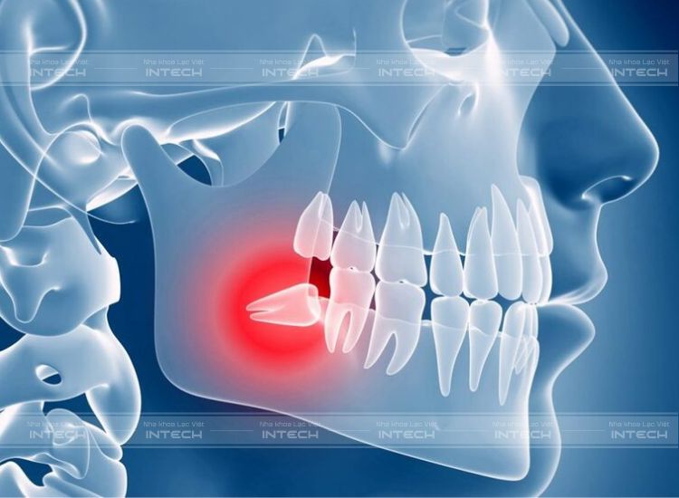 Vị trí mọc của răng 8