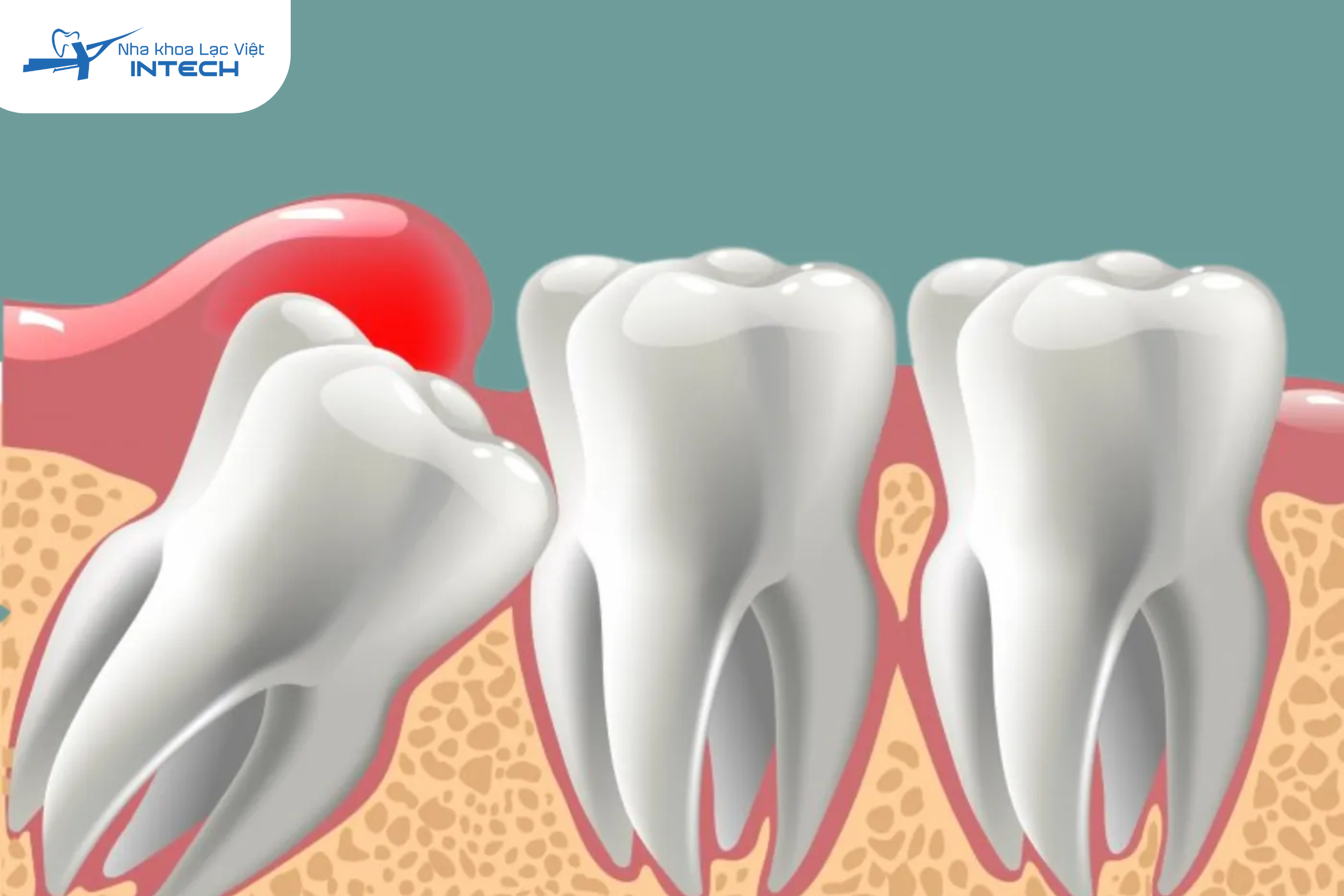 Mọc răng khôn có thể kèm theo sưng và viêm lợi