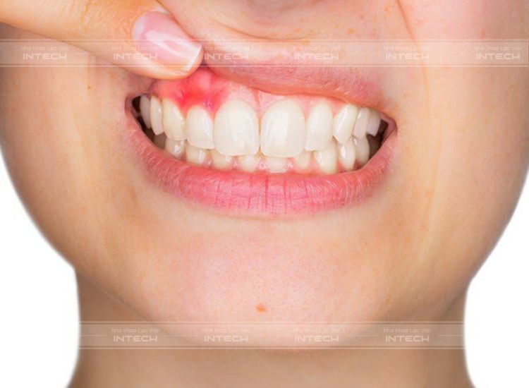 Viêm lợi khiến nướu sưng đỏ