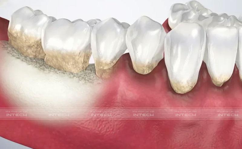 Viêm nha chu khiến vi khuẩn tấn công gây tiêu xương hàm