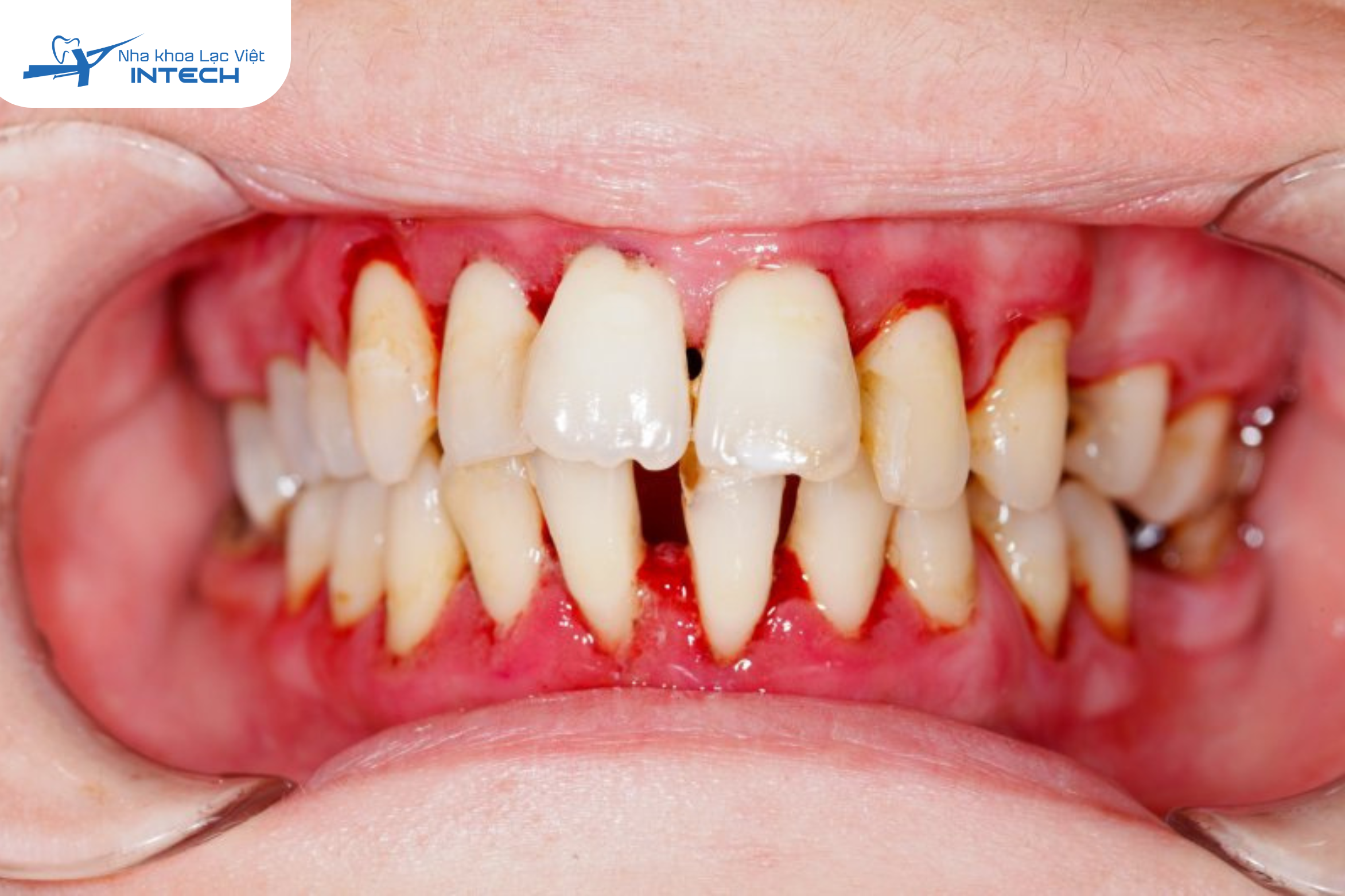 Theo Tổ chức Y tế Thế giới (WHO), viêm quanh răng được xếp vào nhóm 