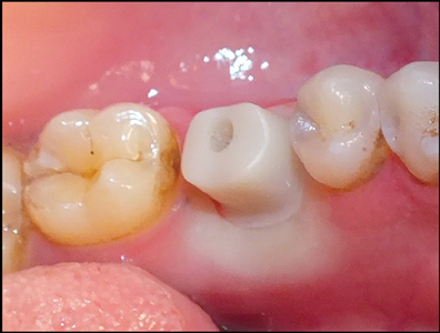 trụ phục hình cá nhân hóa