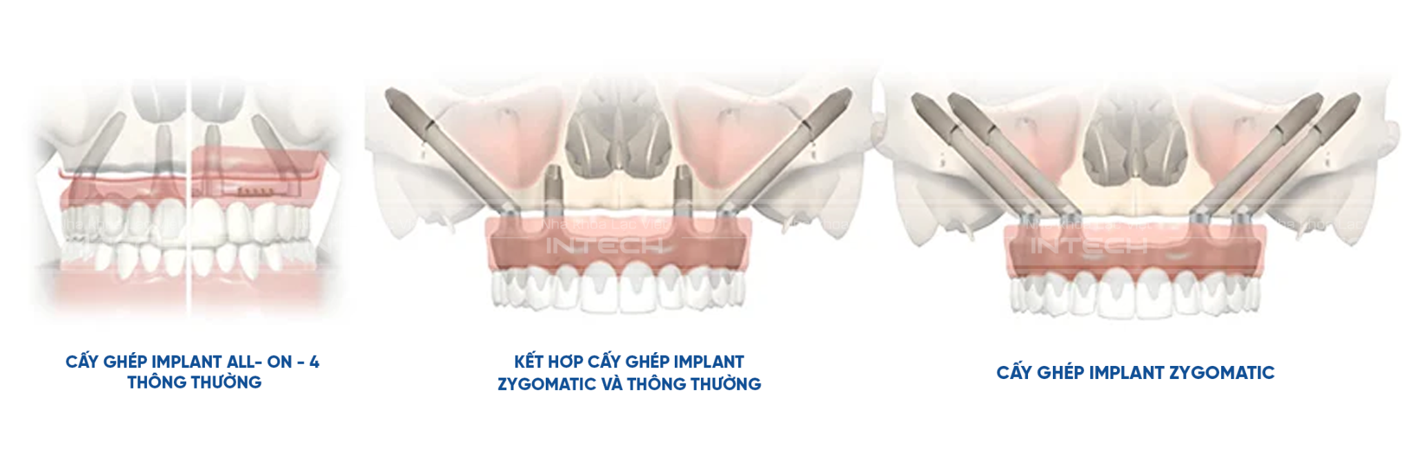 Zygoma implant kết hợp cùng cấy ghép implant thông thường